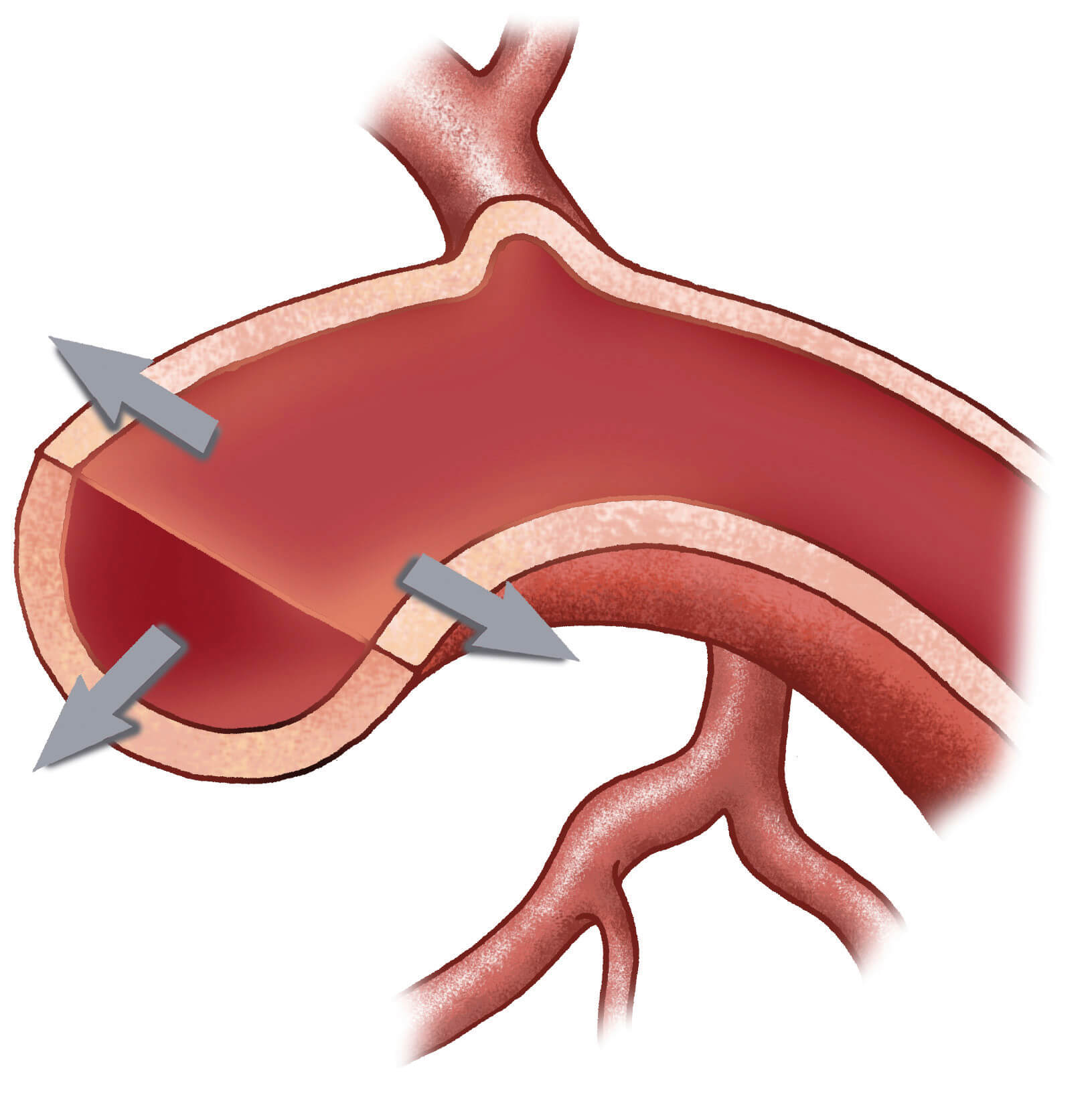 VSVZ80SI-zvisan-krvni-tlak-Krka-okvara-zil